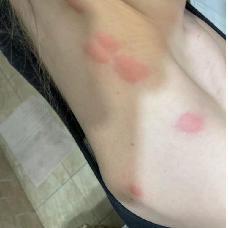 ágyi poloska csípése vállon